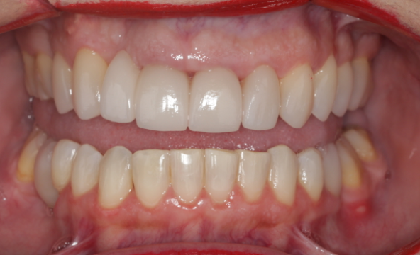uploads/facetas-em porcelana multiodonto paciente 3 depois.png